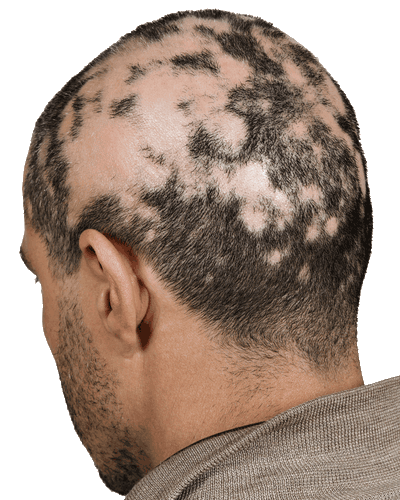 Patient with alopecia