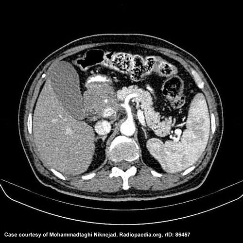 Computer tomography image of pancreatic cancer